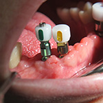 alphatech Abformhiilfen im Mund